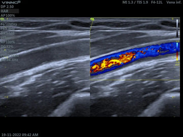 Interpretación de Ecografía Doppler Venosa: Herramientas Clave para el Diagnóstico Vascular