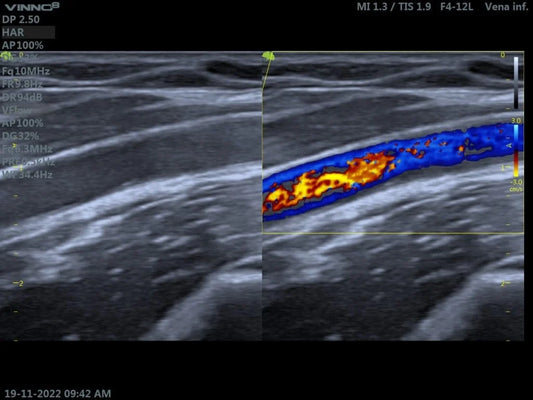 Interpretación de Ecografía Doppler Venosa: Herramientas Clave para el Diagnóstico Vascular