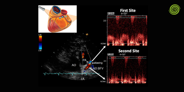 Ecografía Doppler en circulación coronaria