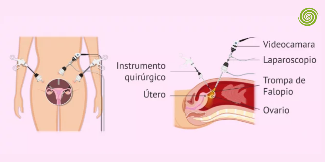 Endoscopia ginecológica