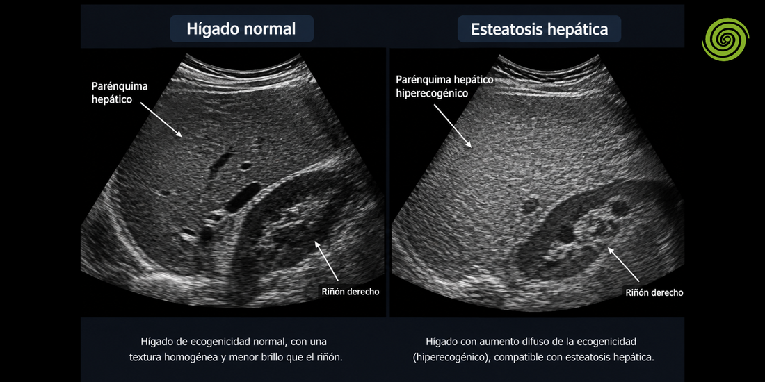 Esteatosis hepática en ecografía