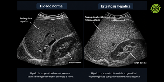 Esteatosis hepática en ecografía