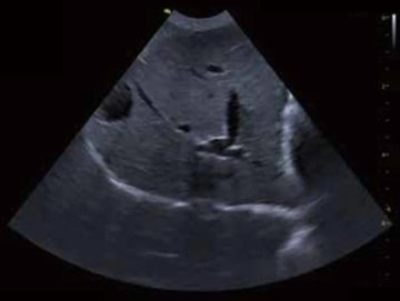 ecografía abdominal