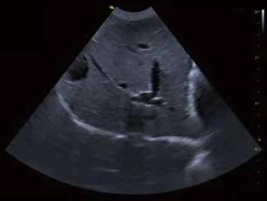 ecografía abdominal