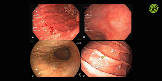 Preparación para una endoscopia