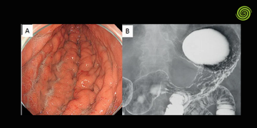Riesgos de la endoscopia