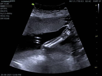 Ultrasonido Abdominal