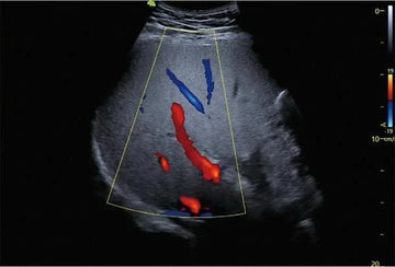 El Poder del Ultrasonido Doppler en la Evaluación Vascular
