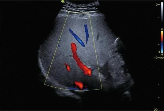 El Poder del Ultrasonido Doppler en la Evaluación Vascular
