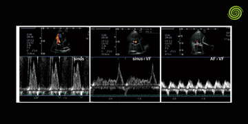 ecografía en arritmias
