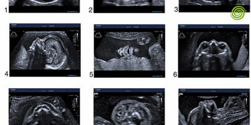 Ecografía morfológica