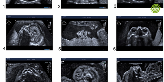 Ecografía morfológica